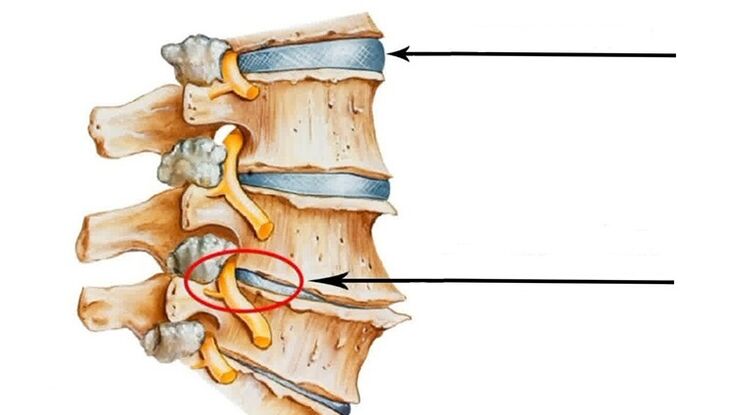 dëmtimi i shtyllës kurrizore në rast të osteokondrozës së qafës së mitrës