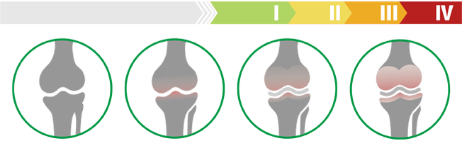 Fazat klinike të artrozës së nyjës së gjurit (shkalla e artrozës së nyjës së gjurit)