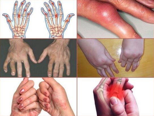 dhimbje në nyjet e gishtave
