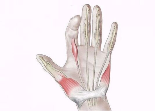 pezmatimi i tendinave si shkaktar i dhimbjes në kyçet e gishtave