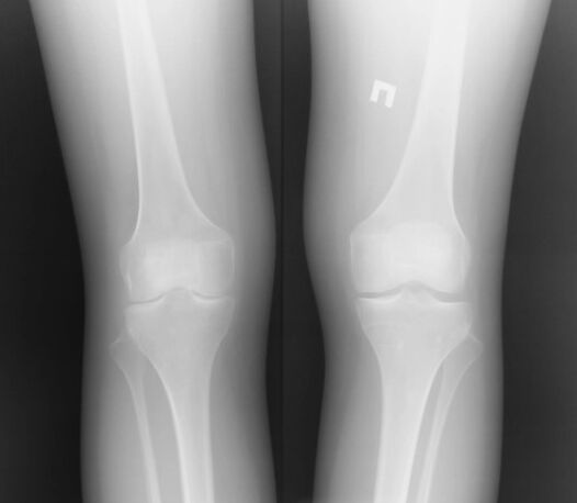 Radiografia e nyjës së gjurit