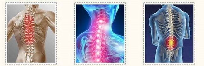 Lezionet kurrizore të osteokondrozës