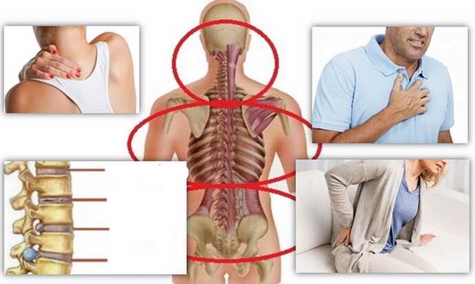 Vendet e sëmundjes për osteokondrozë